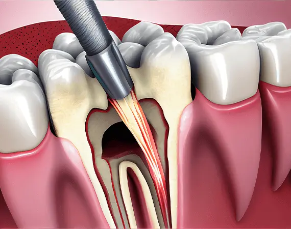 Invisalign